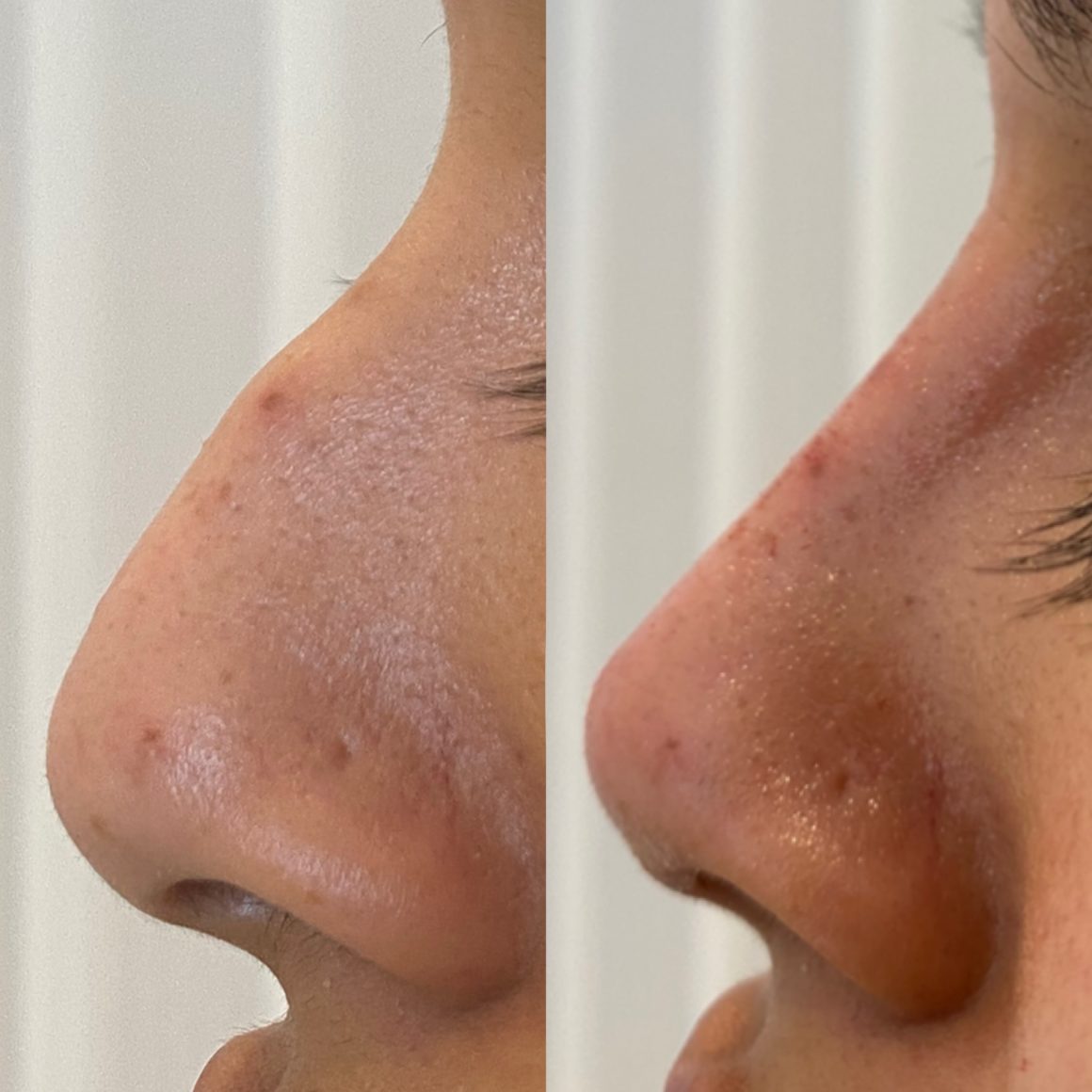 Everything You Need To Know About Nose Filler!