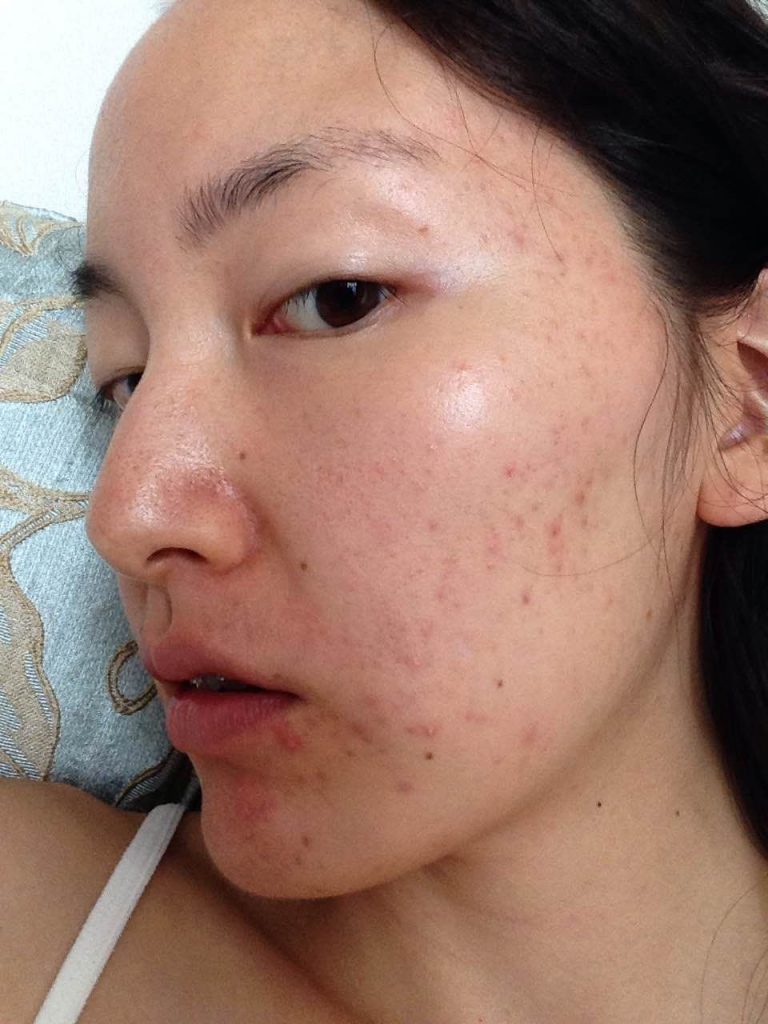 The Second Puberty: Why My Skin Has Changed in My 20’s.