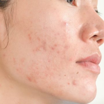 Unveiling the Mystery of Adult Acne in Women: A Comprehensive Scientific Guide