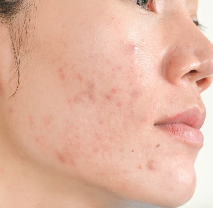 Unveiling the Mystery of Adult Acne in Women: A Comprehensive Scientific Guide