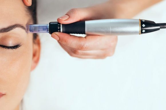 Microneedling: The Secret to Smoother, Firmer Skin